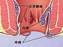 怎么区别肛肠出血性疾病